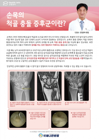 손목의 척골 충돌 증후군이란?